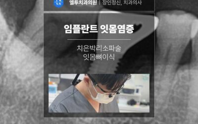 치은박리소파술·잇몸뼈이식·임플란트 잇몸염증 치료에 대한 판단 기준