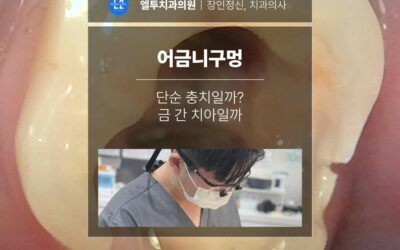 어금니구멍, 단순 충치일까? 금 간 치아일까