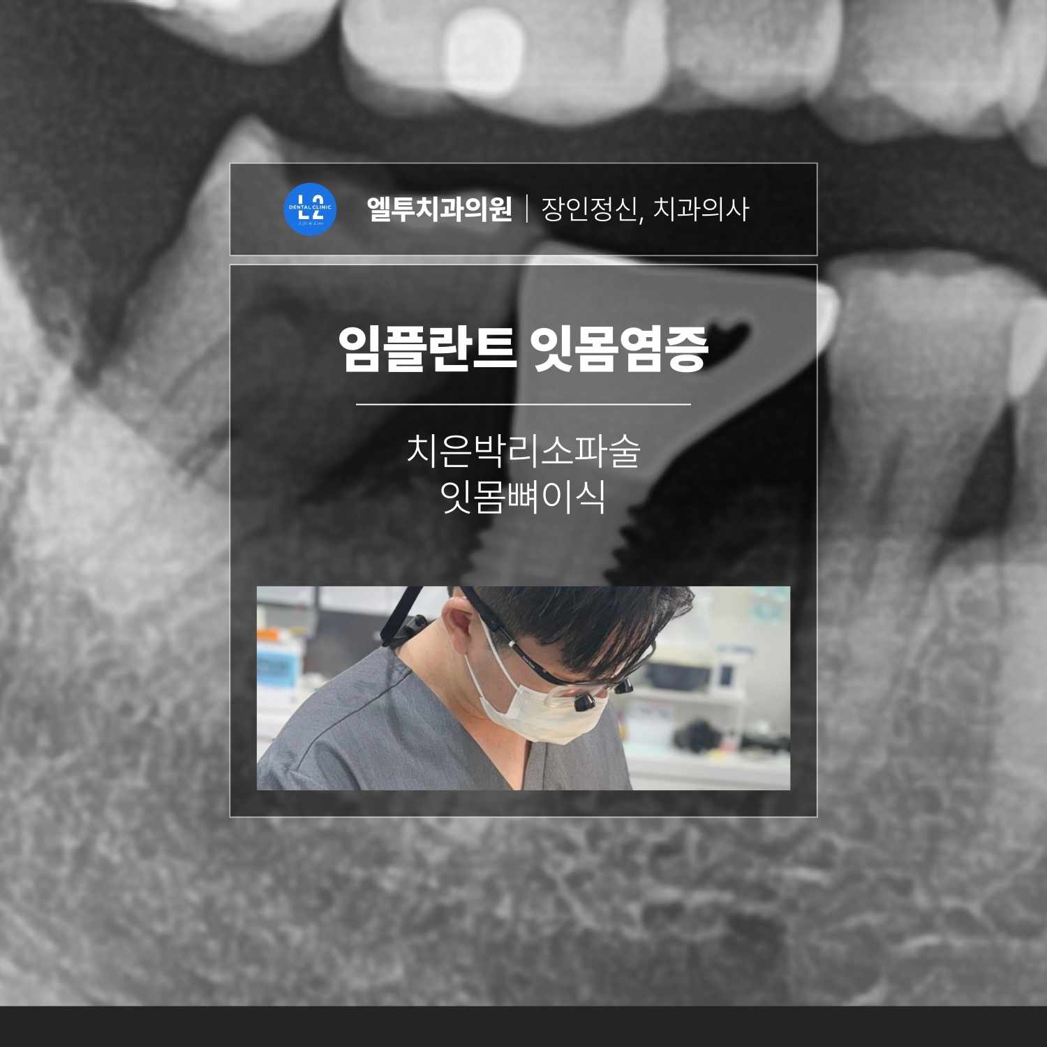 임플란트 잇몸염증으로 치은박리소파술과 잇몸뼈이식을 설명하는 엘투치과 임상 이미지