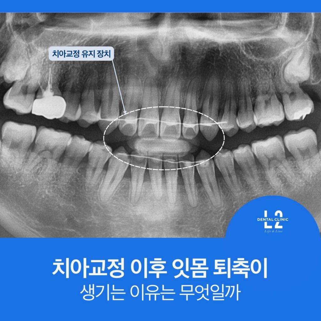 치아교정 유지장치가 보이는 파노라마 엑스레이와 전치부 잇몸 변화