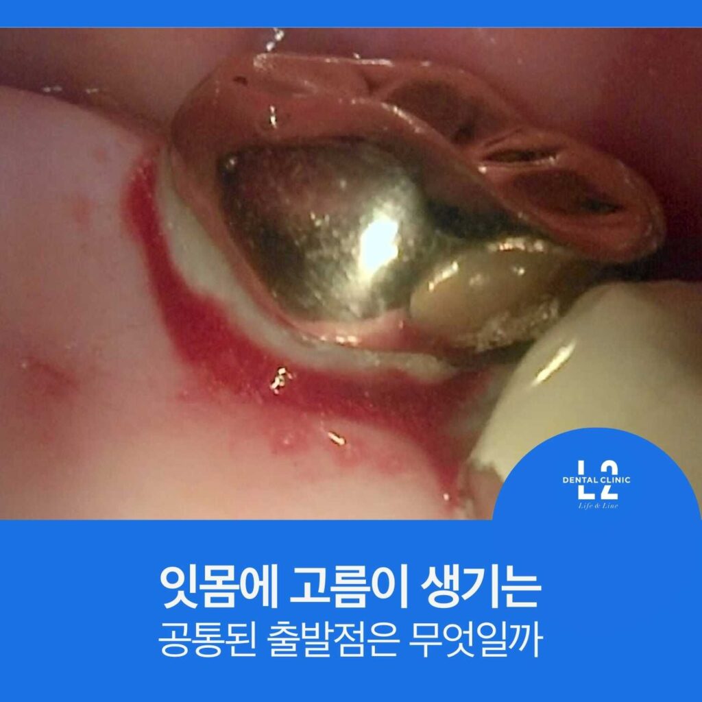 잇몸에 고름이 형성되는 어금니 부위와 염증 반응 모습