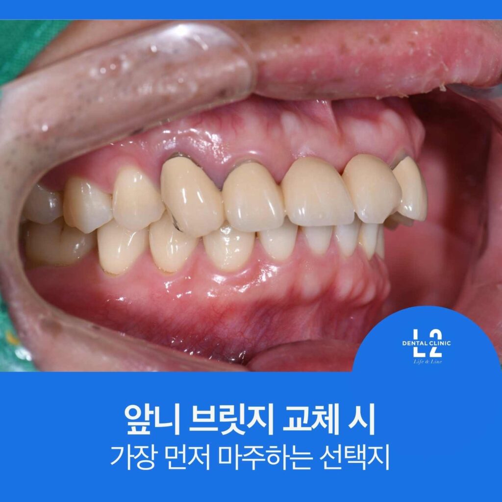 앞니 브릿지가 장착된 구강 내 측면 사진