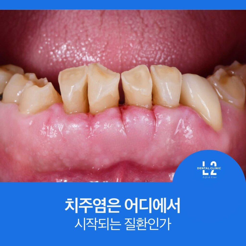 치주염으로 잇몸이 붓고 아래 앞니가 정출된 구강 사진