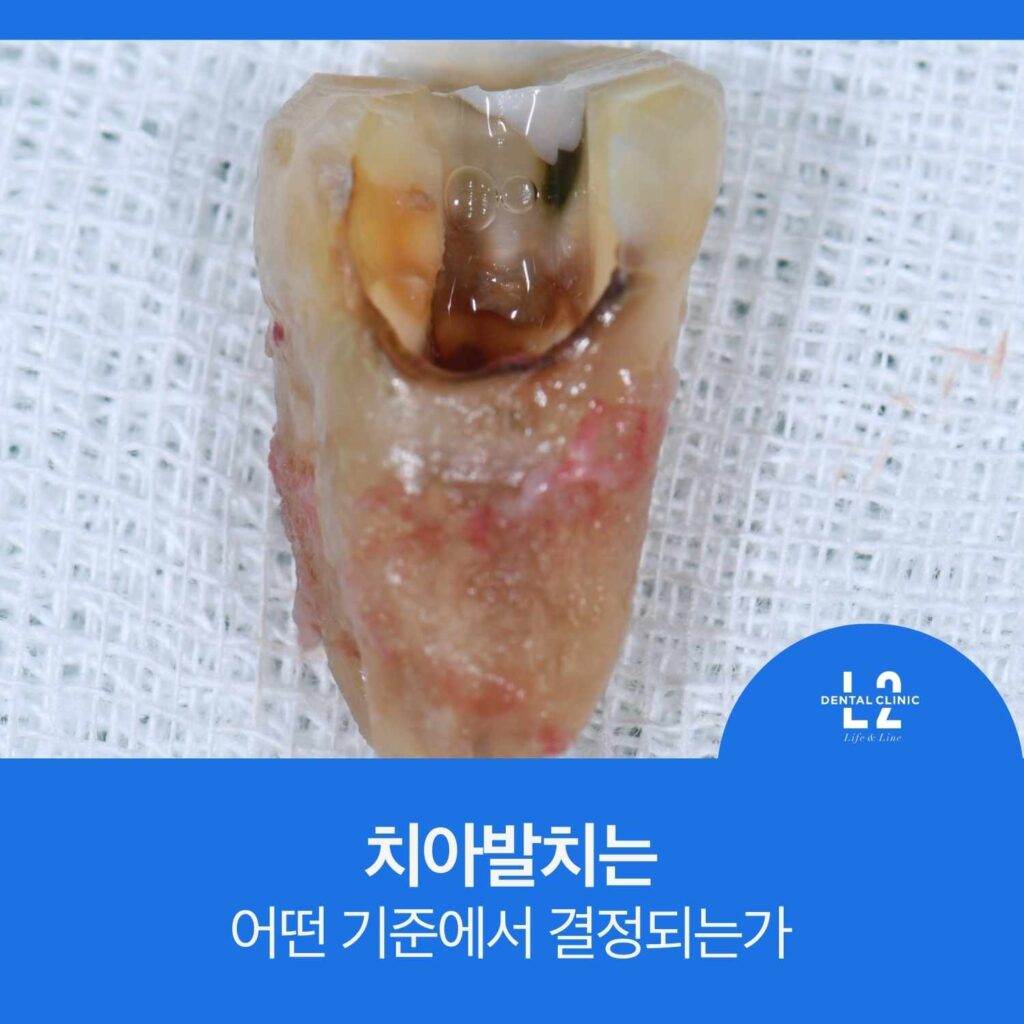심한 충치로 인해 치아발치된 치아의 모습