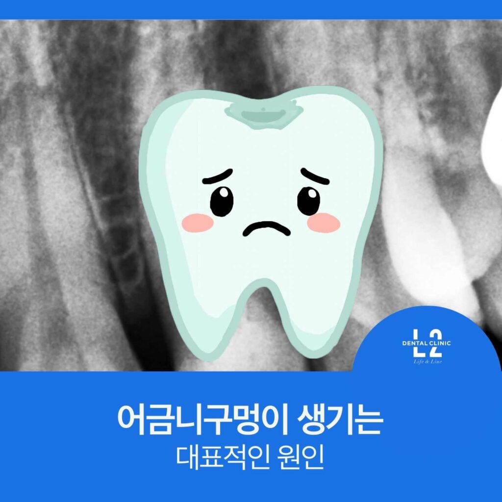 어금니 엑스레이 사진 위에 슬픈 표정의 치아 일러스트가 겹쳐진 이미지