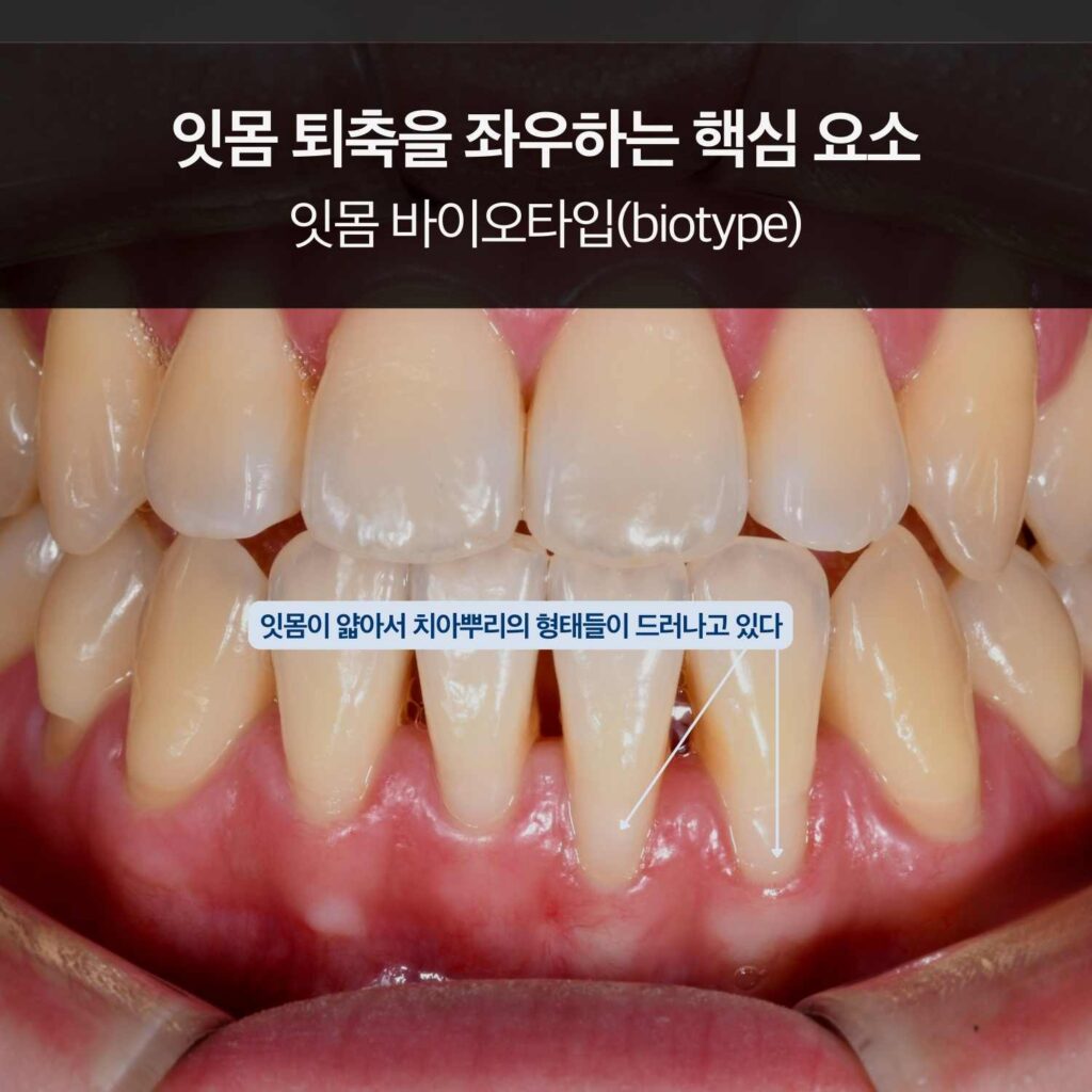 잇몸이 얇아 치아 뿌리 윤곽이 드러난 전치부 사진으로 잇몸 바이오타입을 설명하는 이미지