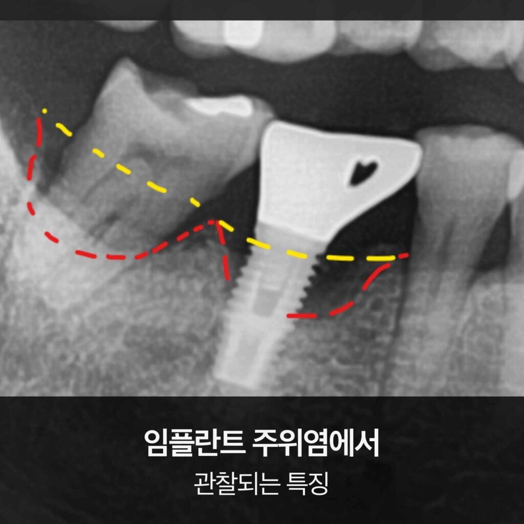 임플란트 주위염으로 인한 분화구 형태의 잇몸뼈 흡수가 보이는 엑스레이