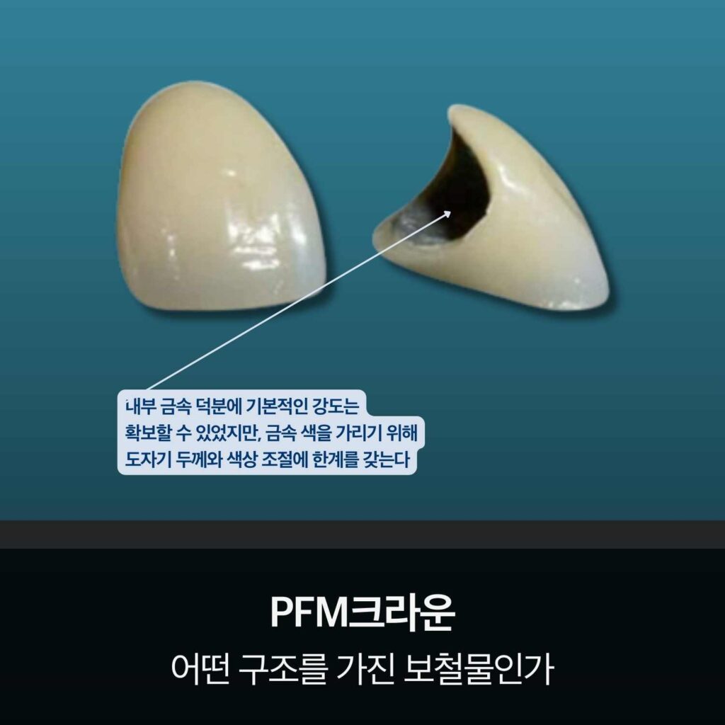 금속 코핑 위에 도자기가 결합된 PFM크라운 단면 구조