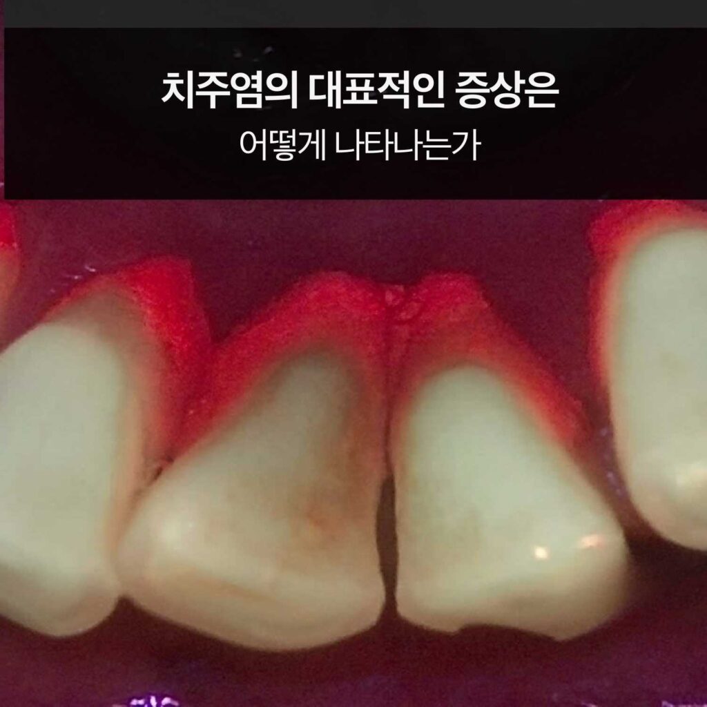 치주염으로 붉게 변한 잇몸과 출혈 양상