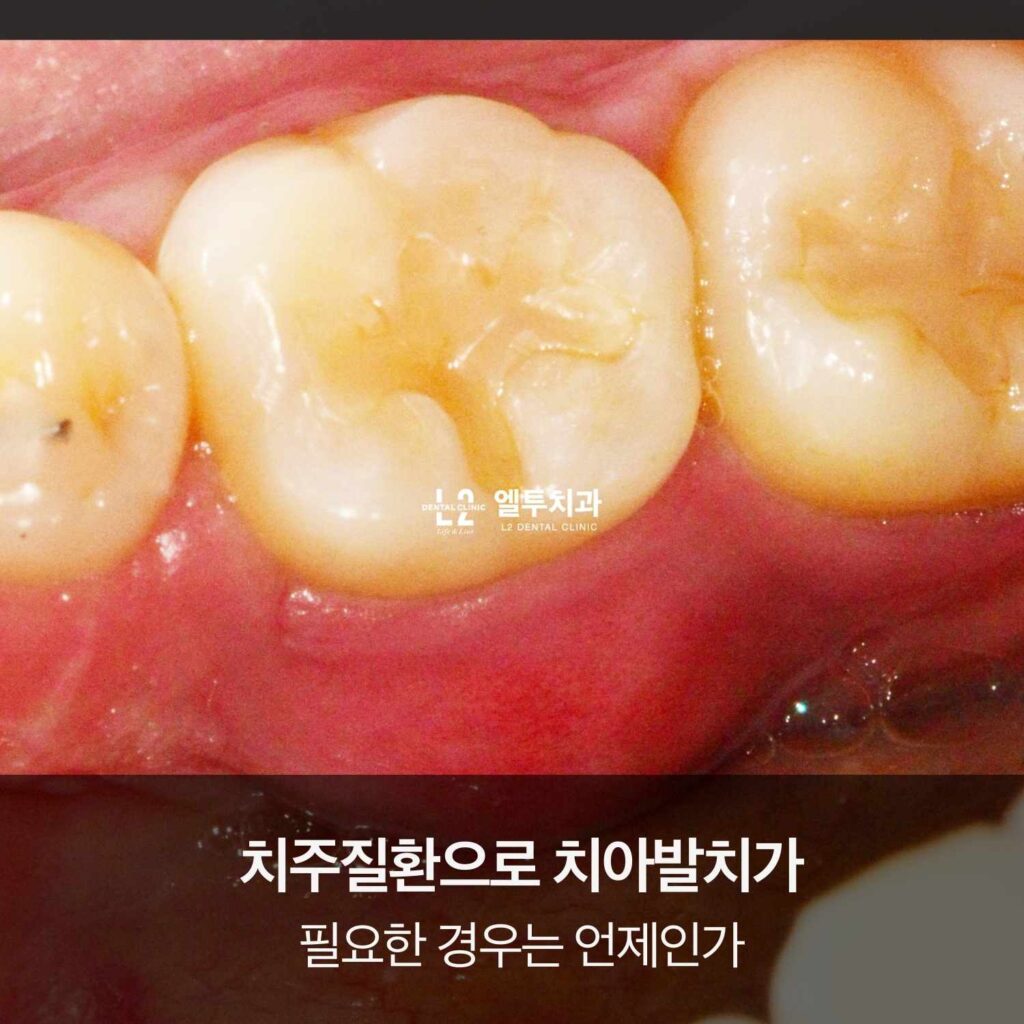 치주질환으로 잇몸 염증이 진행된 어금니 사진