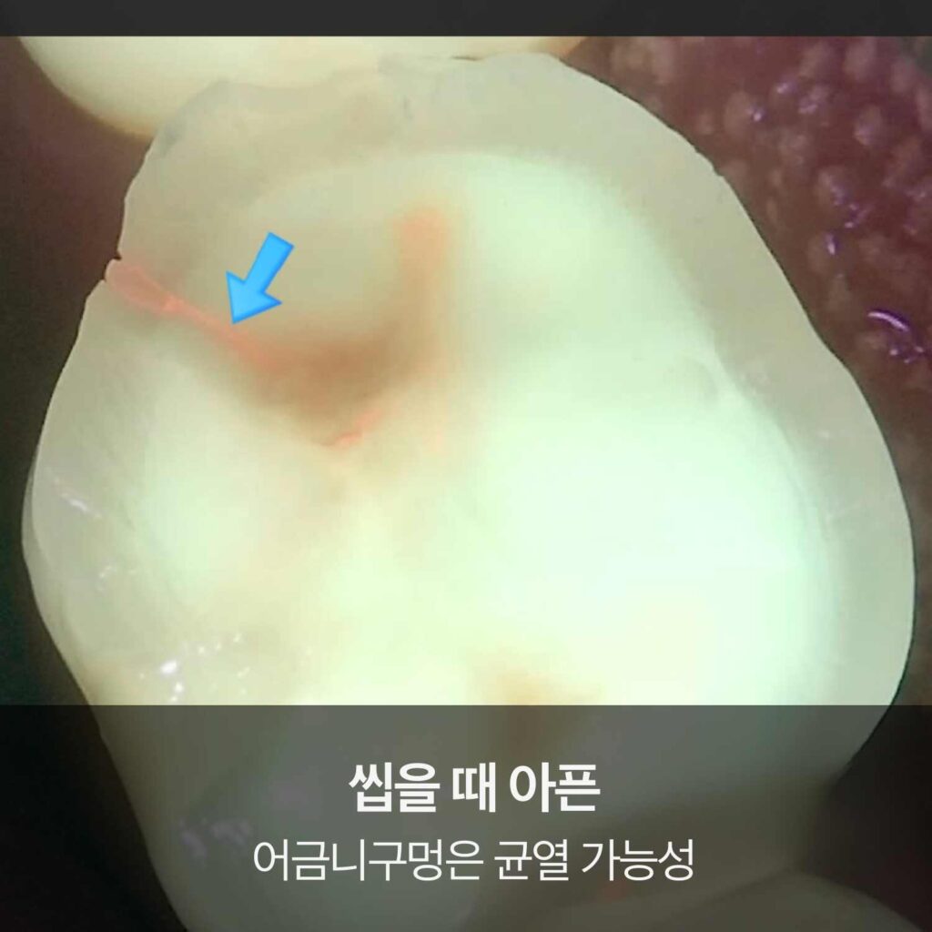 어금니 교합면에 붉은 형광으로 표시된 균열 부위를 화살표로 가리킨 확대 구강 사진