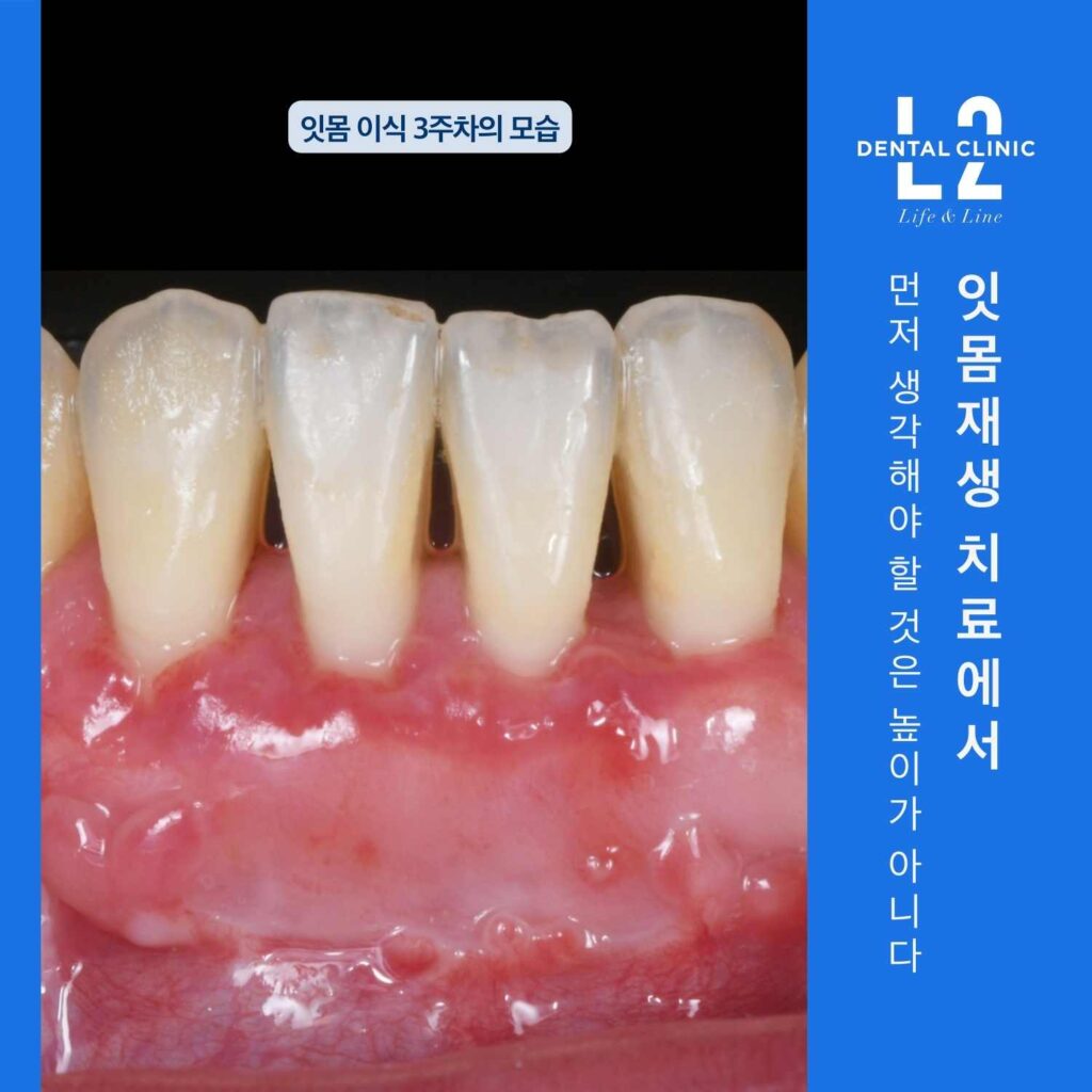 치은이식 후 3주 차에 관찰되는 잇몸 조직의 치유 모습