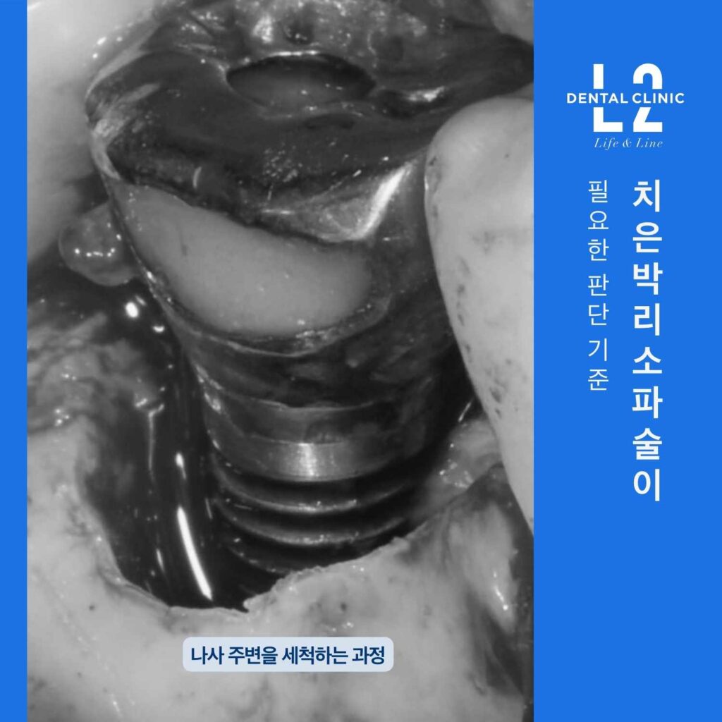 치은박리소파술로 임플란트 나사 주변을 세척하는 임상 장면