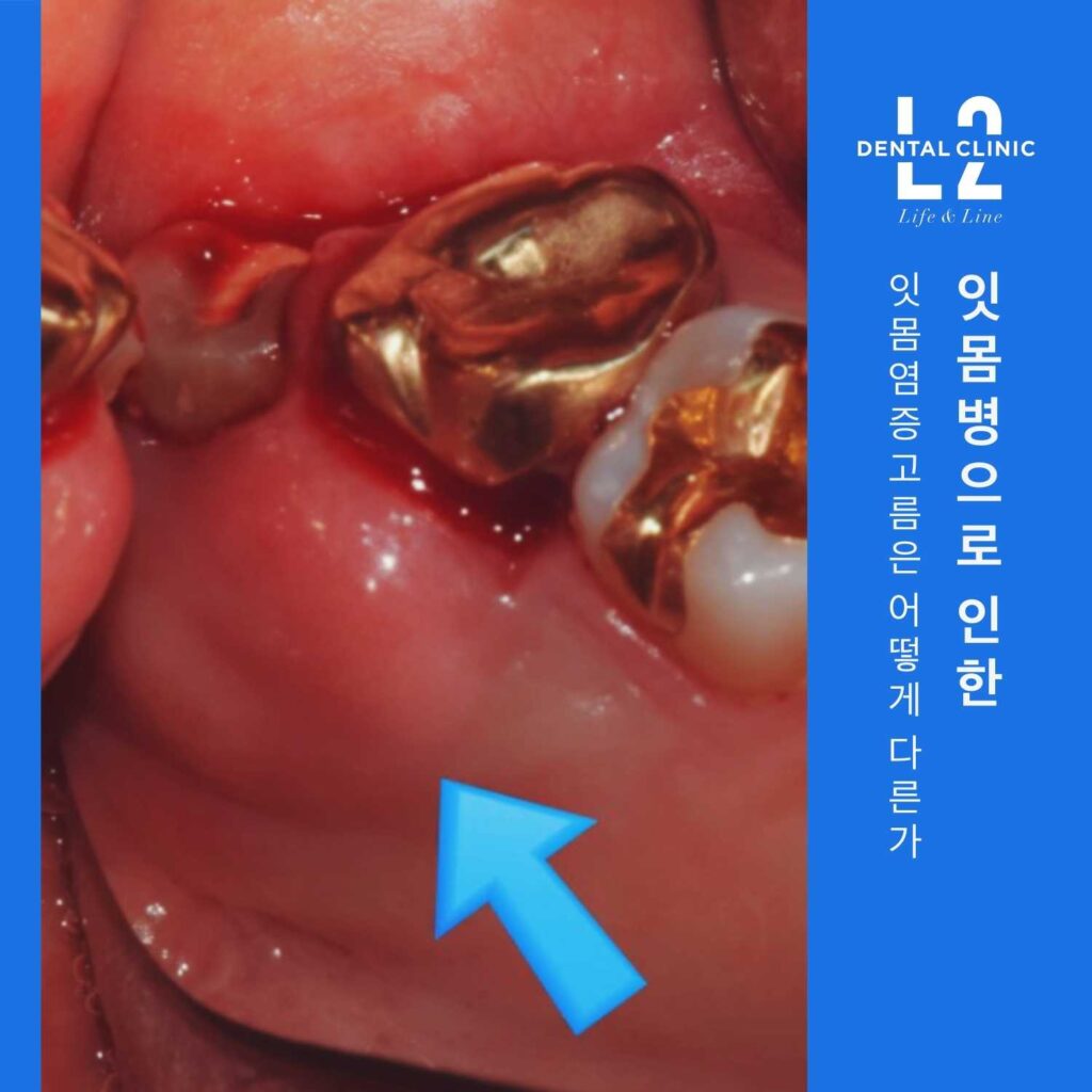 치주질환으로 인해 잇몸이 붓고 고름이 형성된 어금니 주변 모습