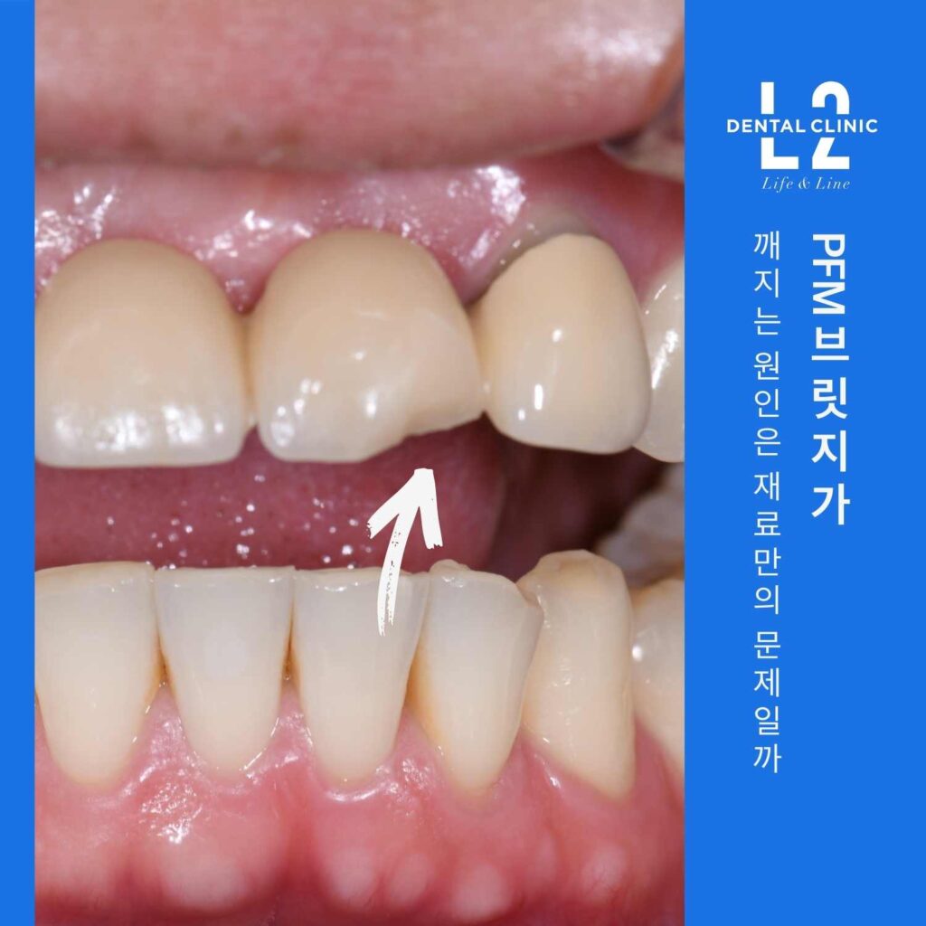 앞니 PFM 브릿지에서 도자기가 깨져 금속이 노출된 모습