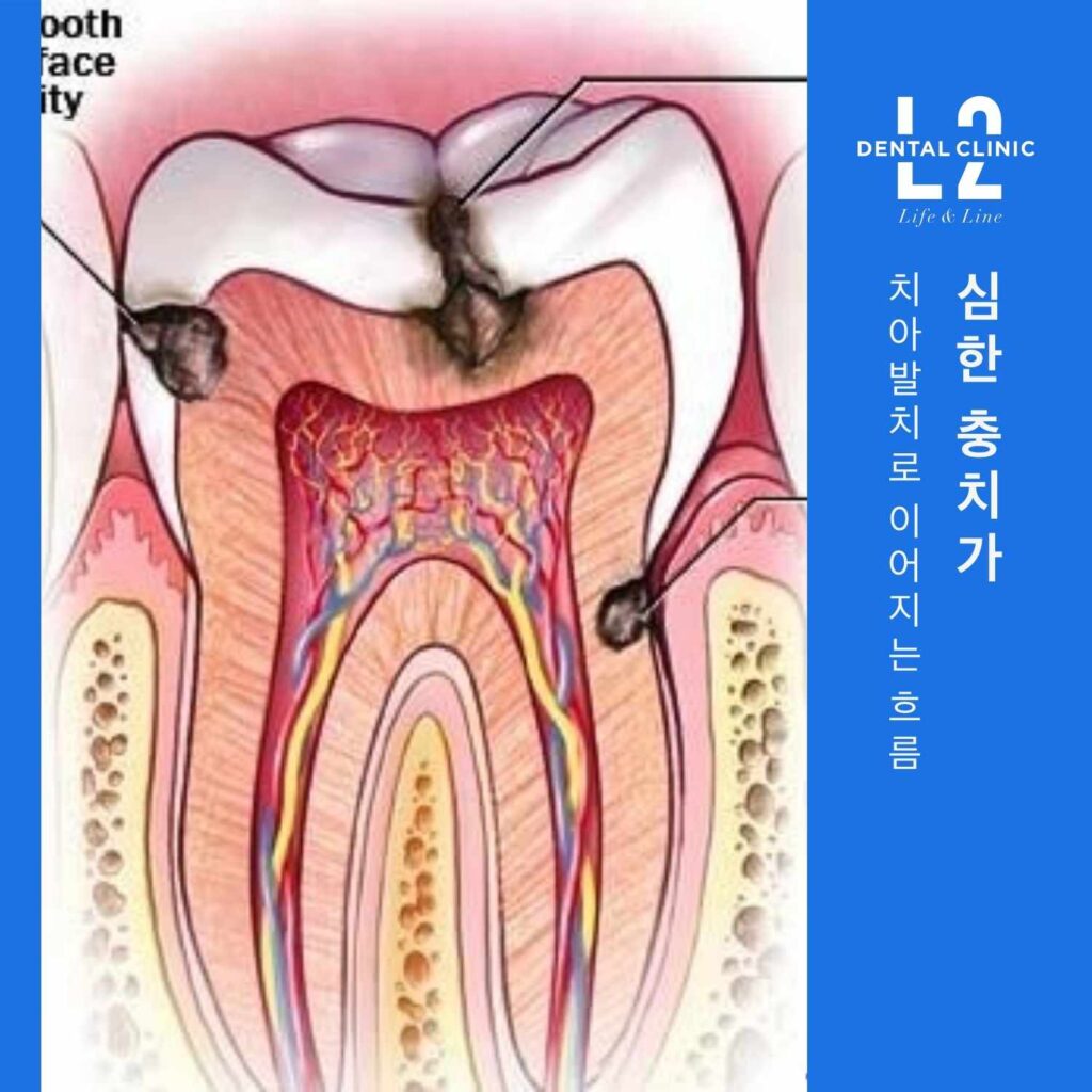 충치가 신경과 뿌리까지 진행되는 과정을 보여주는 그림