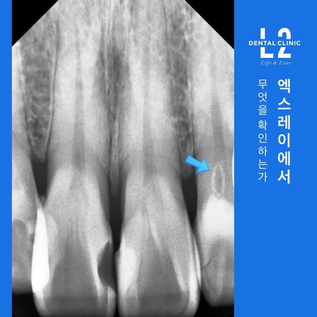 앞니 엑스레이에서 배꼽 모양으로 보이는 치내치 구조