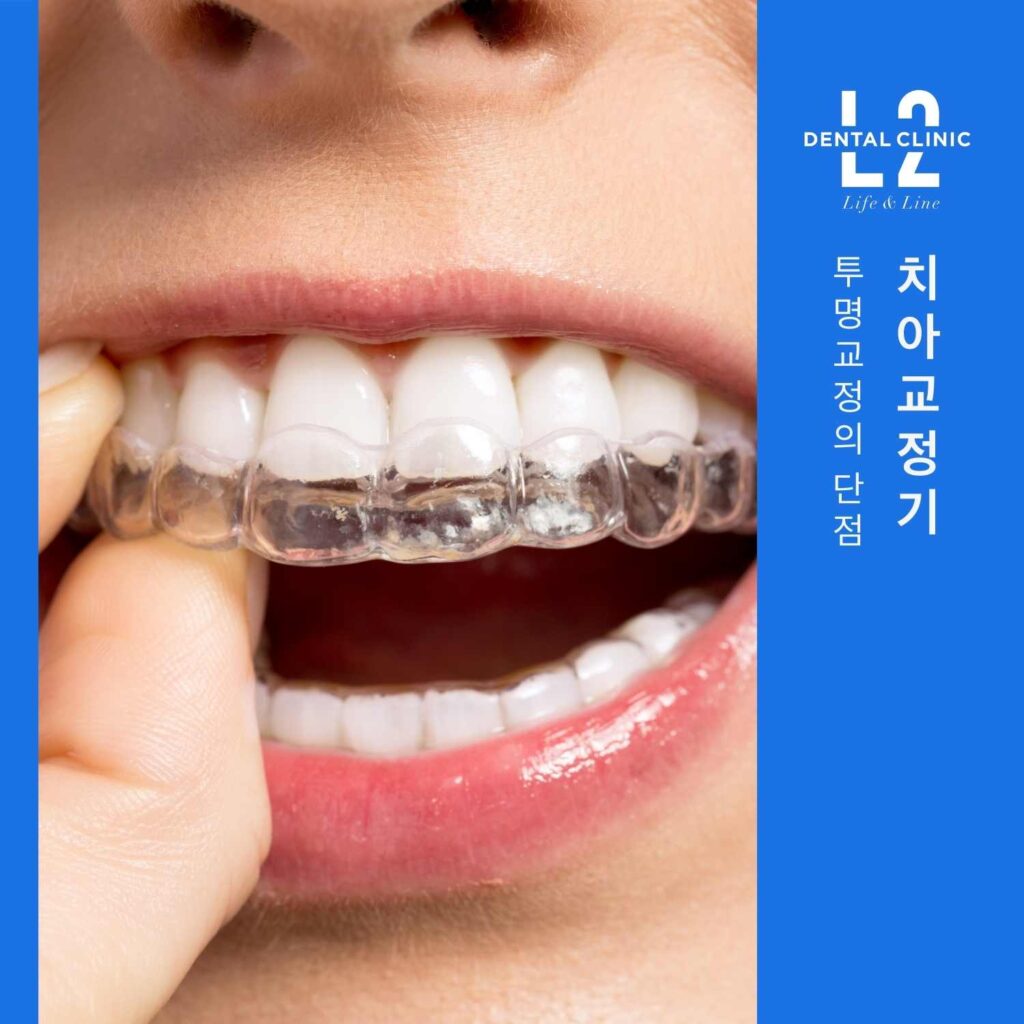 치아에서 투명교정기를 제거하는 모습으로 본 투명교정의 단점 설명 이미지
