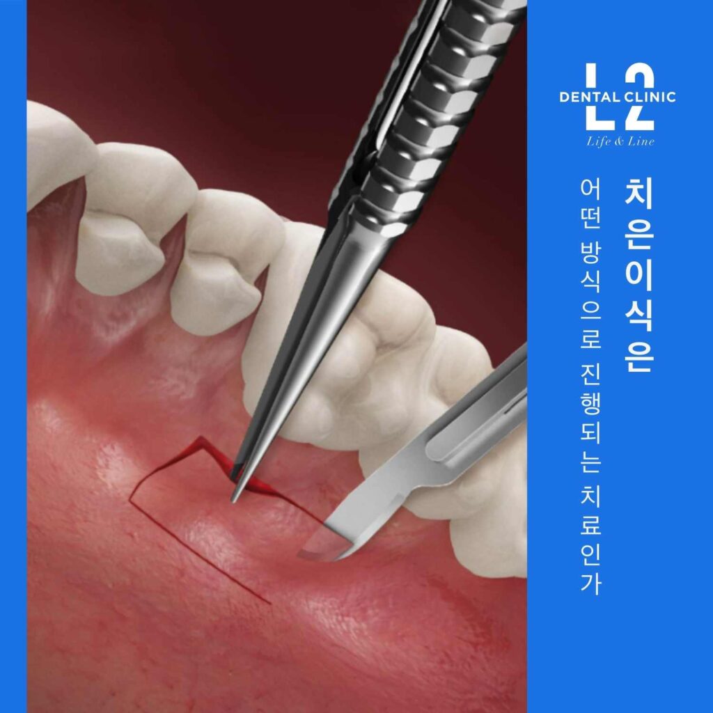 치은이식이 어떤 방식으로 진행되는지를 보여주는 일러스트 이미지