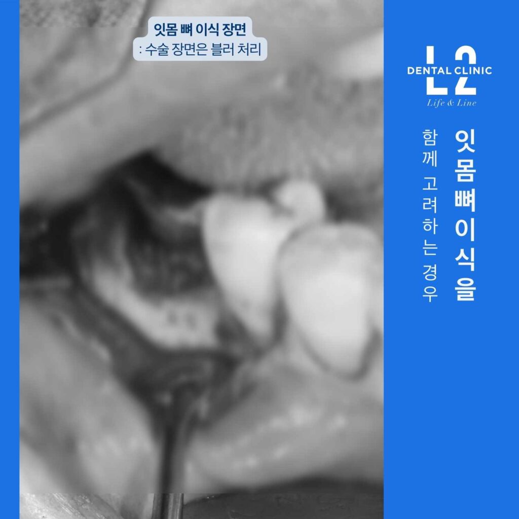 임플란트 주위염으로 인한 잇몸뼈 소실 부위에 잇몸뼈이식을 시행하는 장면