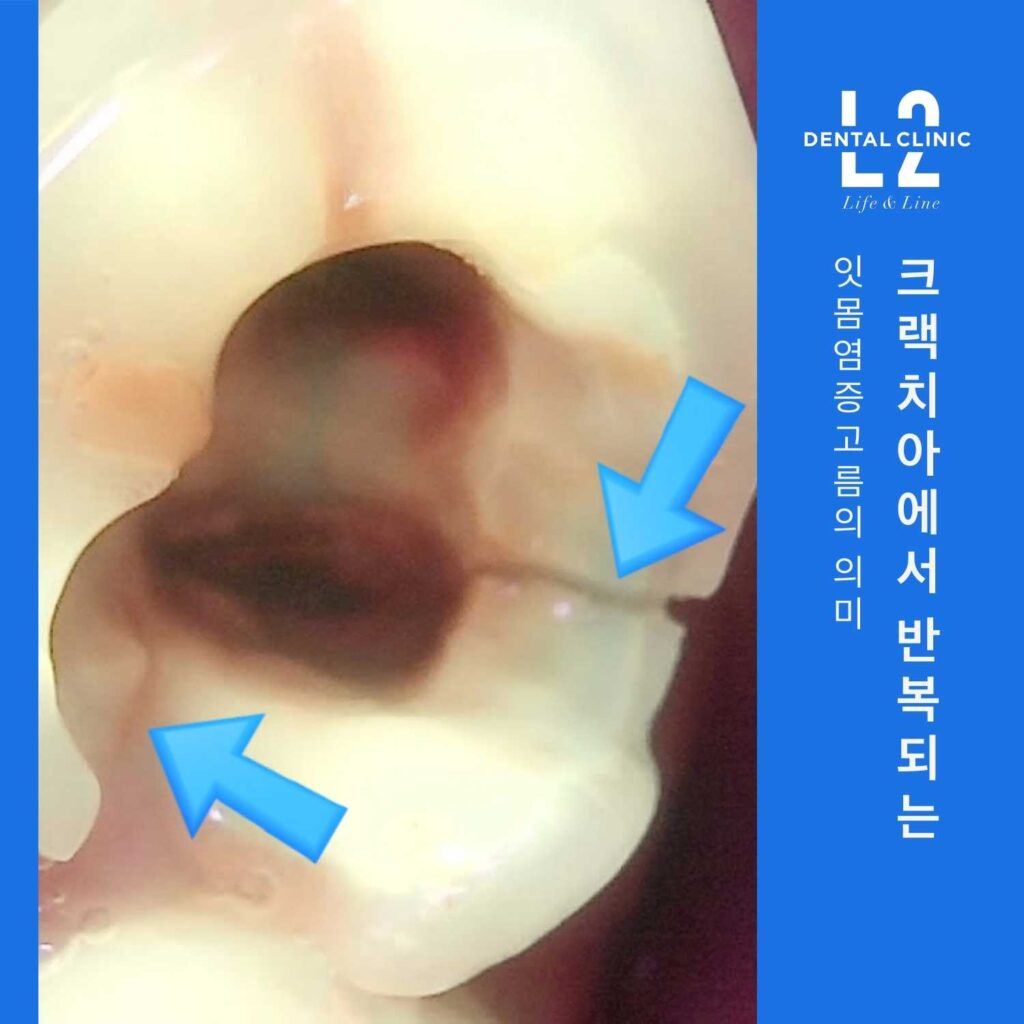 치아 균열 부위에서 반복적으로 발생하는 잇몸염증고름 모습