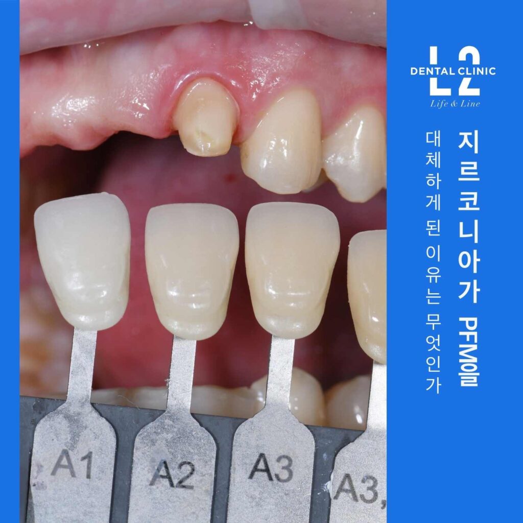 앞니 보철물 색상 선택을 위해 쉐이드 가이드를 대보는 모습