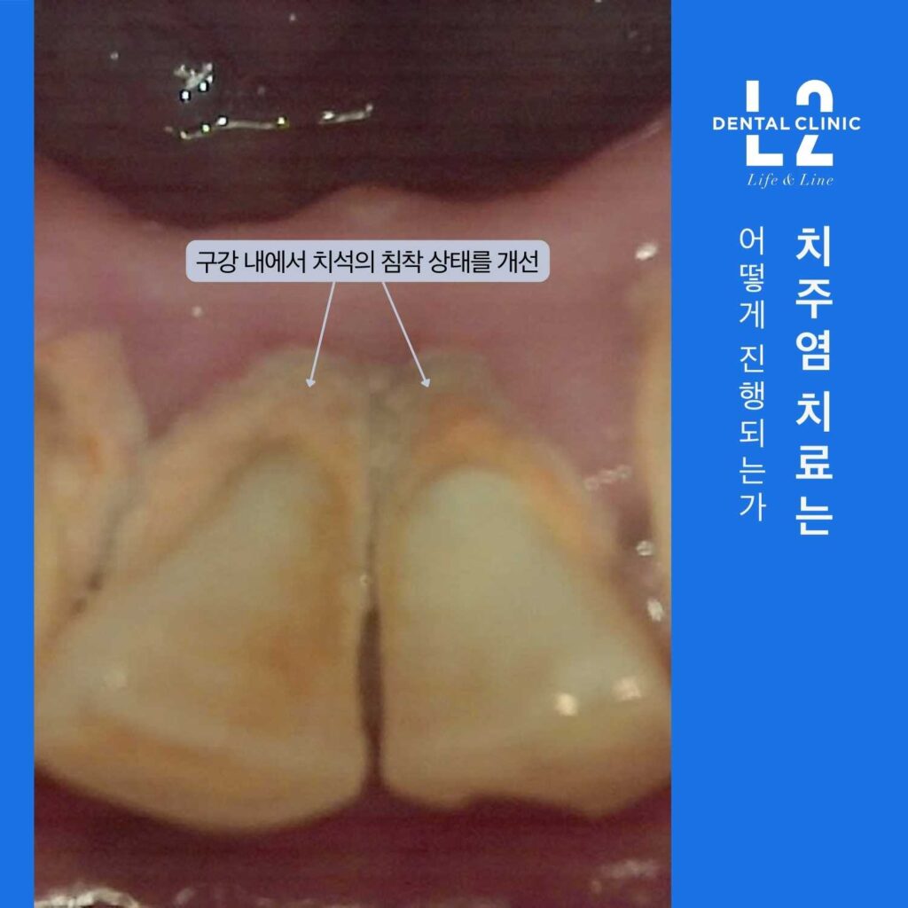 아래 앞니 안쪽에 치석이 침착된 모습