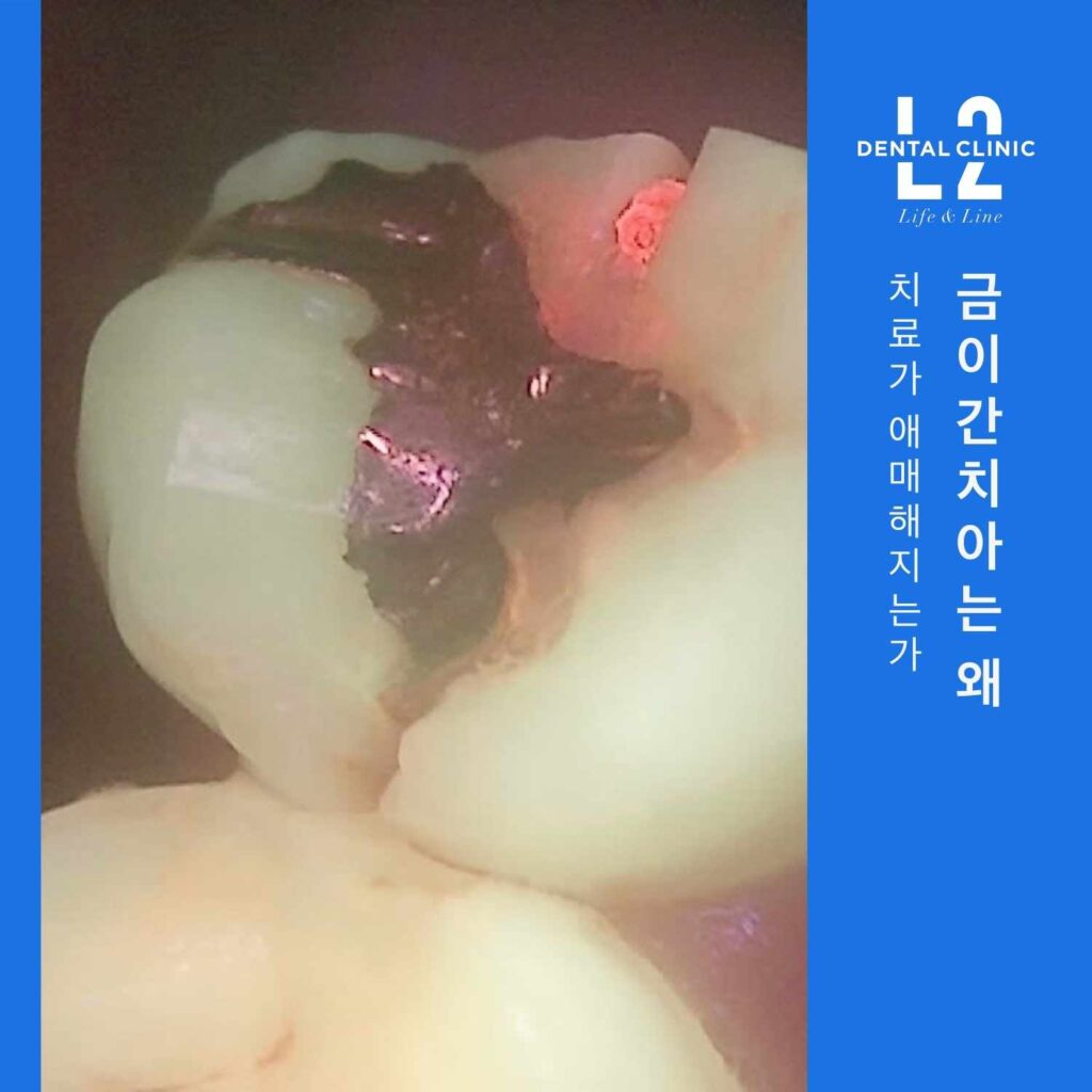 수직 파절로 금이 간 치아의 임상 사진