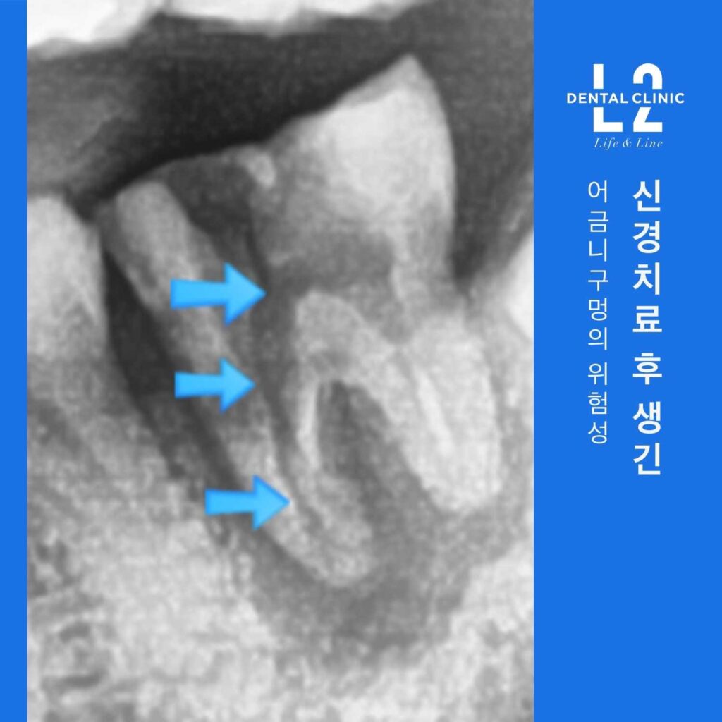 신경치료 후 크라운을 하지 않아 구조적으로 약해진 어금니 뿌리 부위 엑스레이 사진