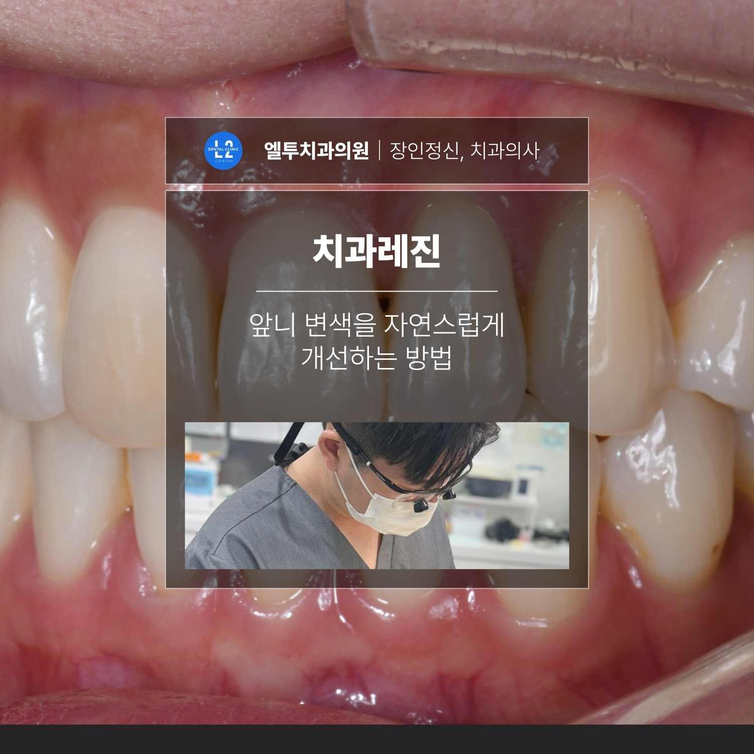 치과레진 치료로 앞니 변색을 자연스럽게 개선하는 방법을 설명하는 엘투치과 임상 사례 이미지