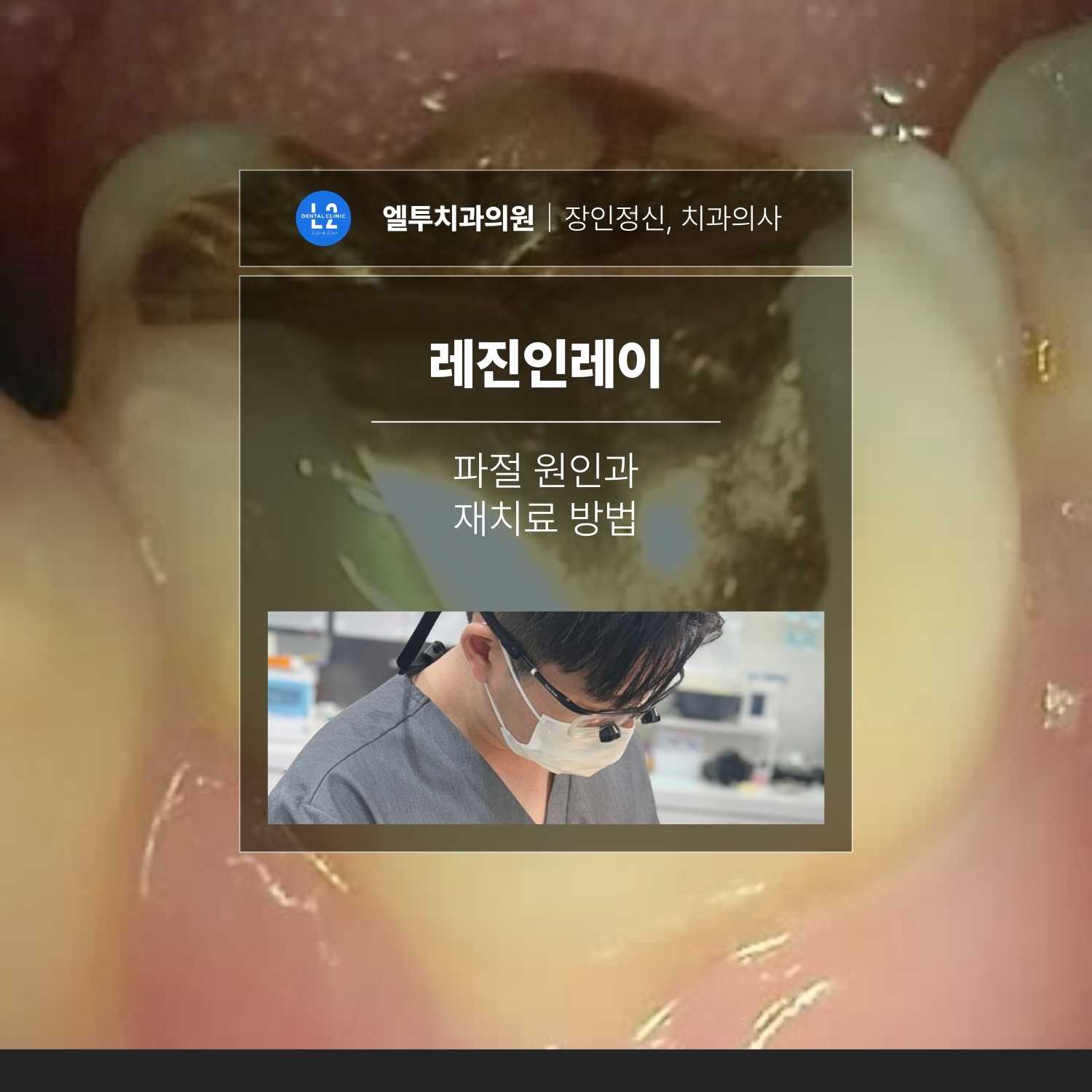 레진인레이 파절 원인과 재치료 방법을 설명하는 치과 치료 사례
