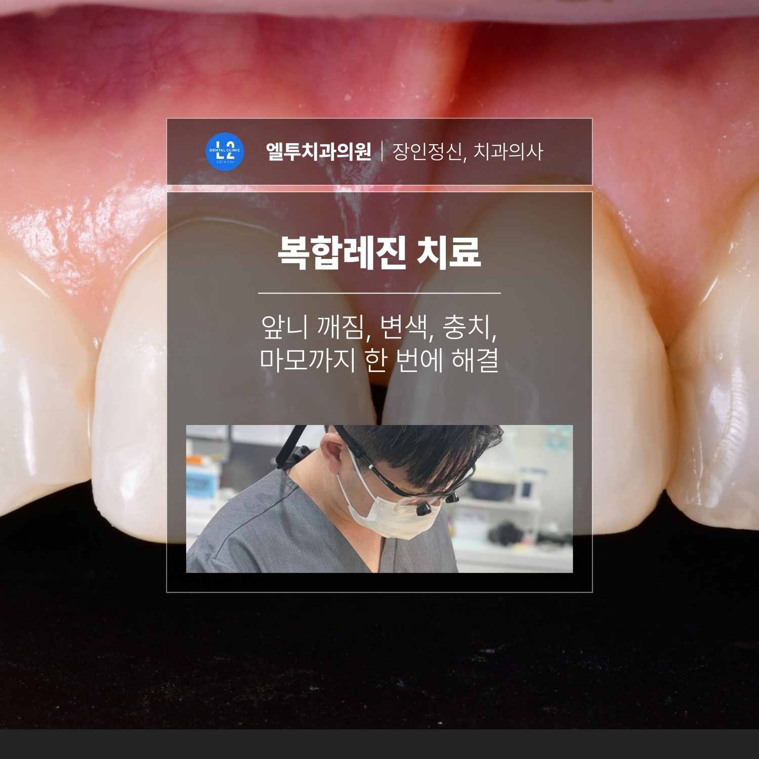 복합레진 치료로 앞니 깨짐 변색 충치 마모를 개선하는 치과 치료