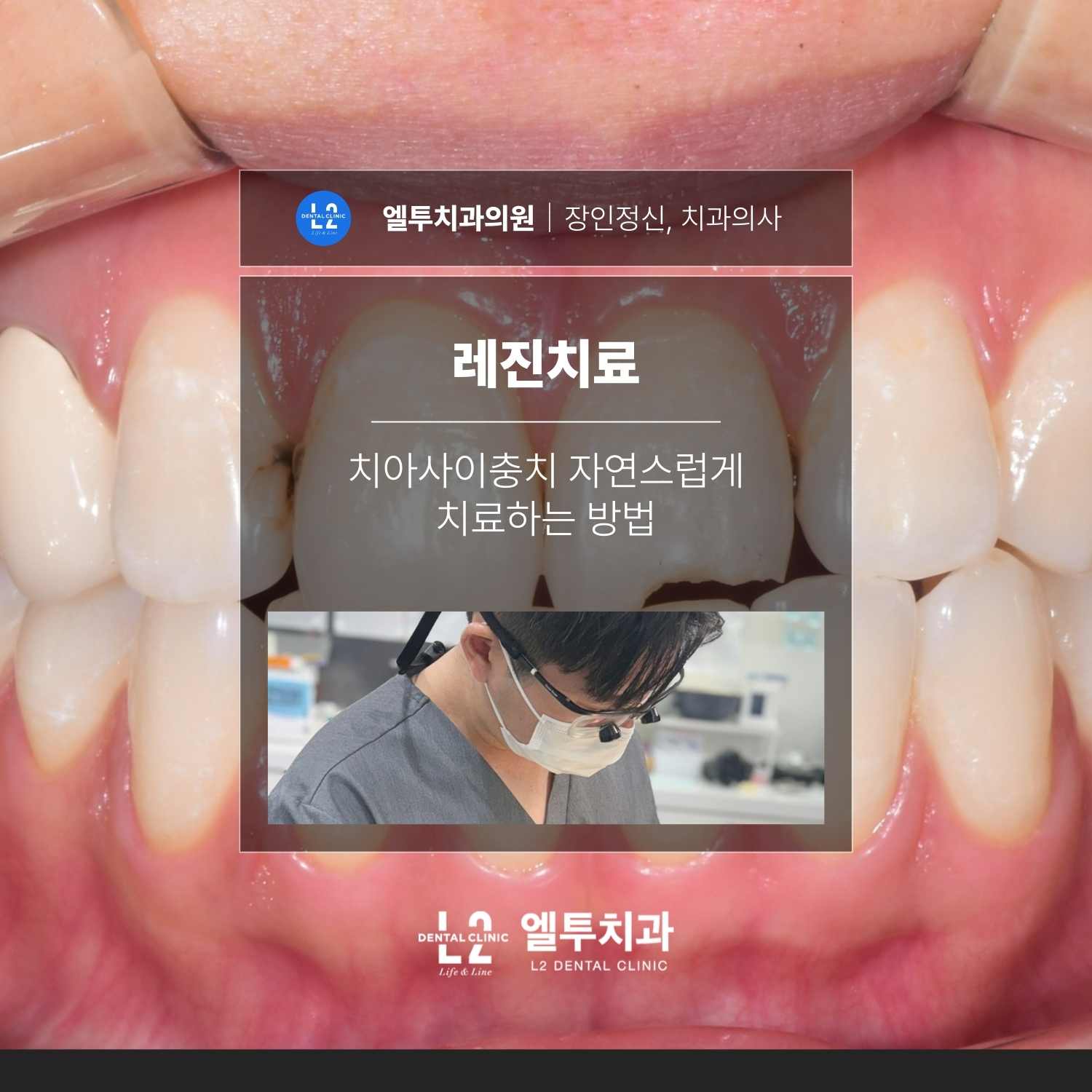 앞니 치아사이충치를 레진치료로 자연스럽게 치료하는 사례 설명 이미지