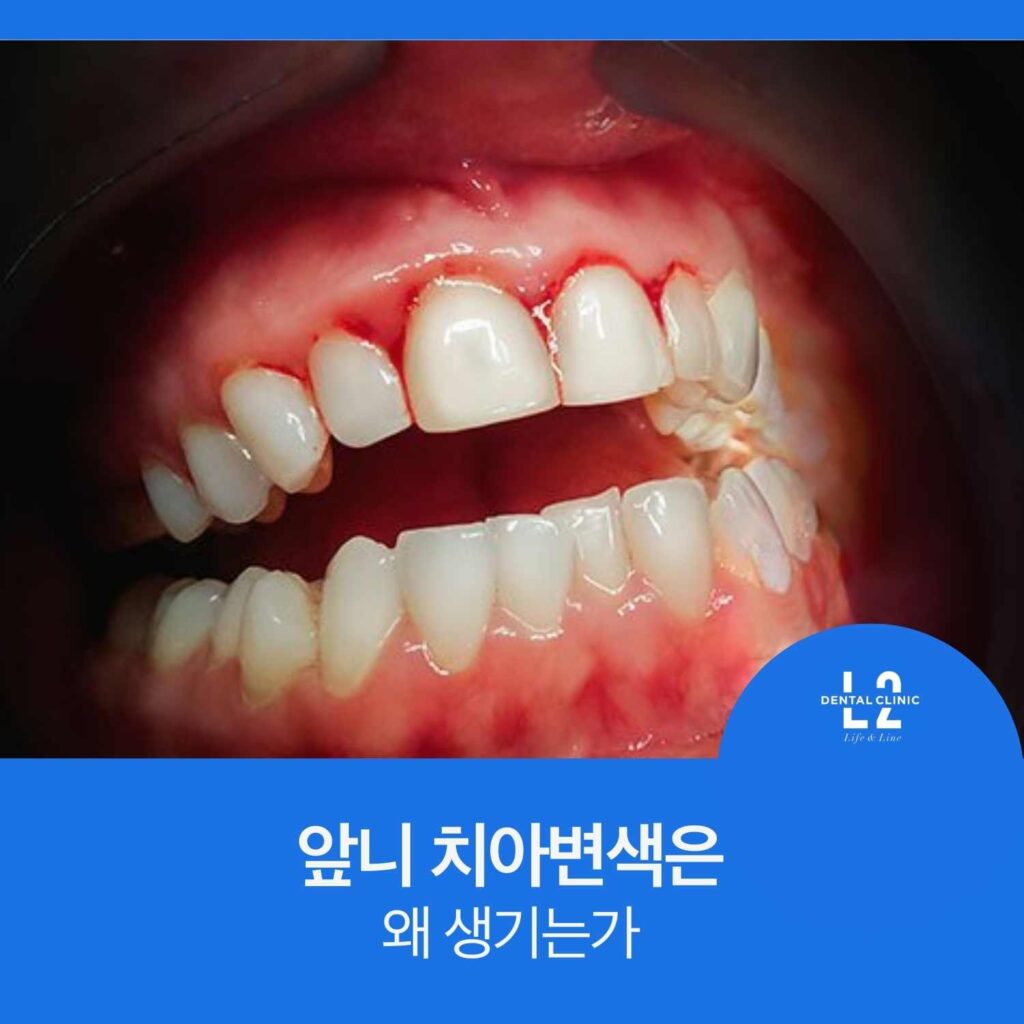 앞니 치아변색이 발생하는 원인을 설명하는 구강 사진