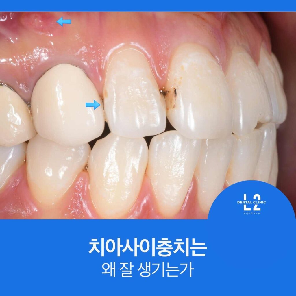 앞니 치아 사이 접촉면에 발생한 치아사이충치 임상 사진
