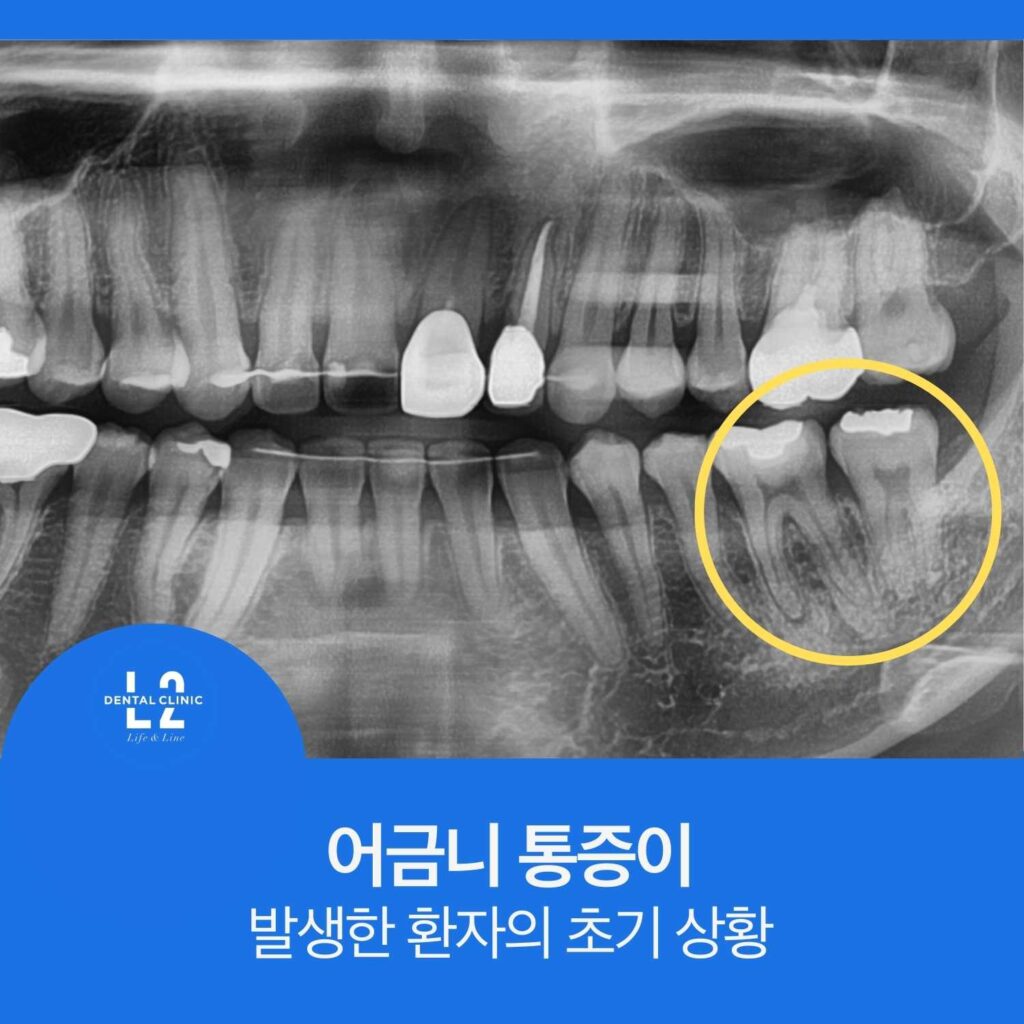 골드인레이 치료 치아에서 어금니통증이 발생한 환자의 초기 파노라마 엑스레이