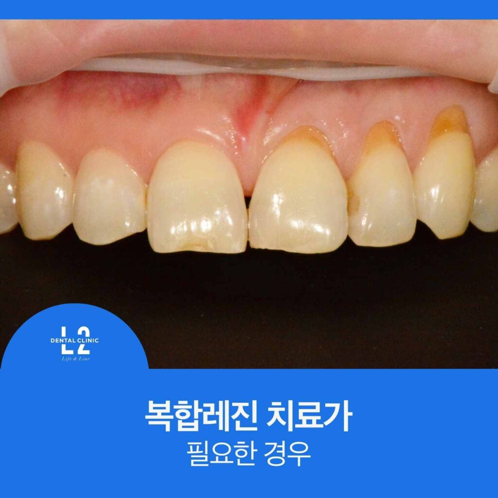 복합레진 치료가 필요한 앞니 깨짐 변색 치경부마모증 사례