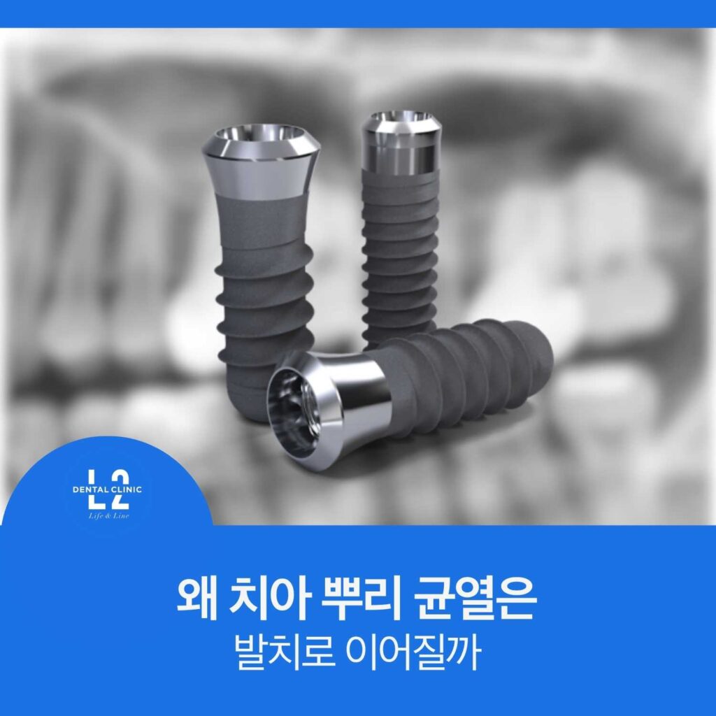 스트라우만 임플란트 구조와 치아 뿌리 균열 관련 이미지