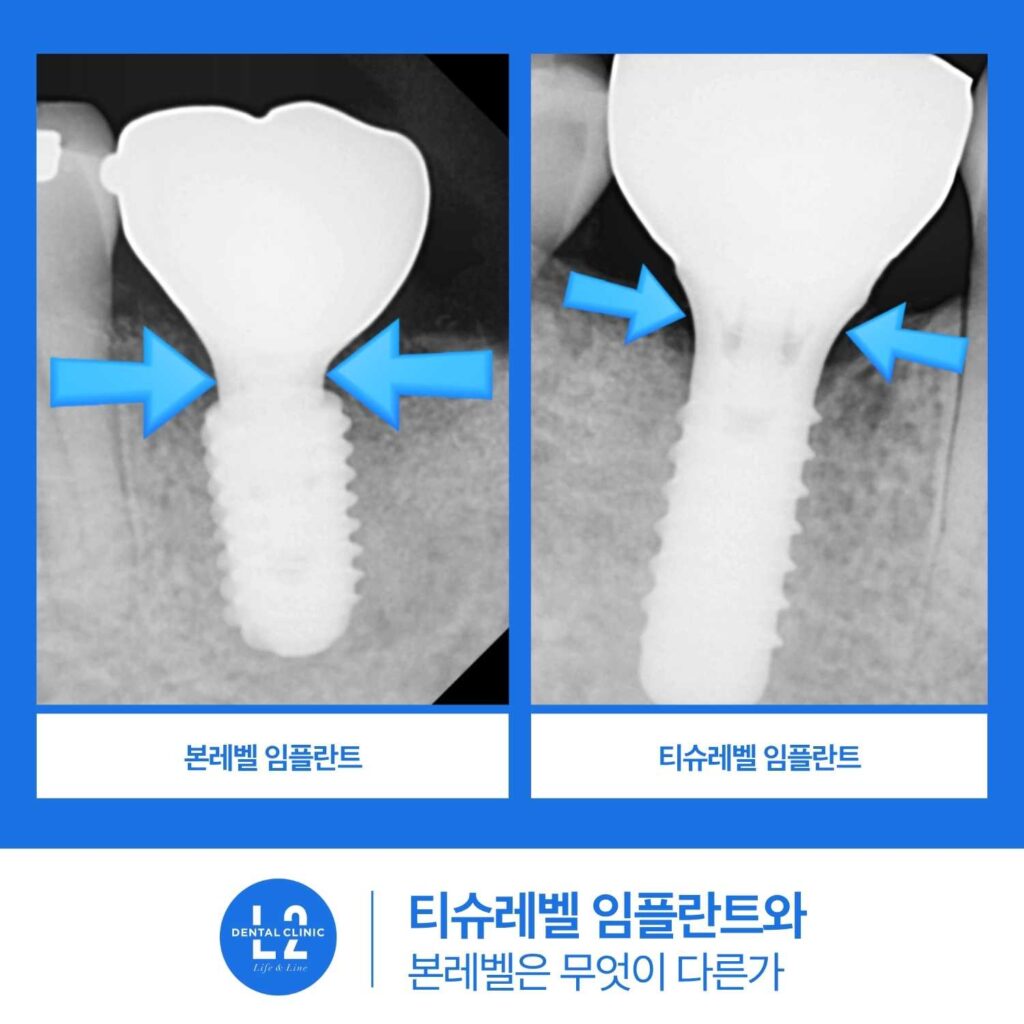 본레벨 임플란트와 티슈레벨 임플란트 구조 차이를 비교한 X-ray 이미지