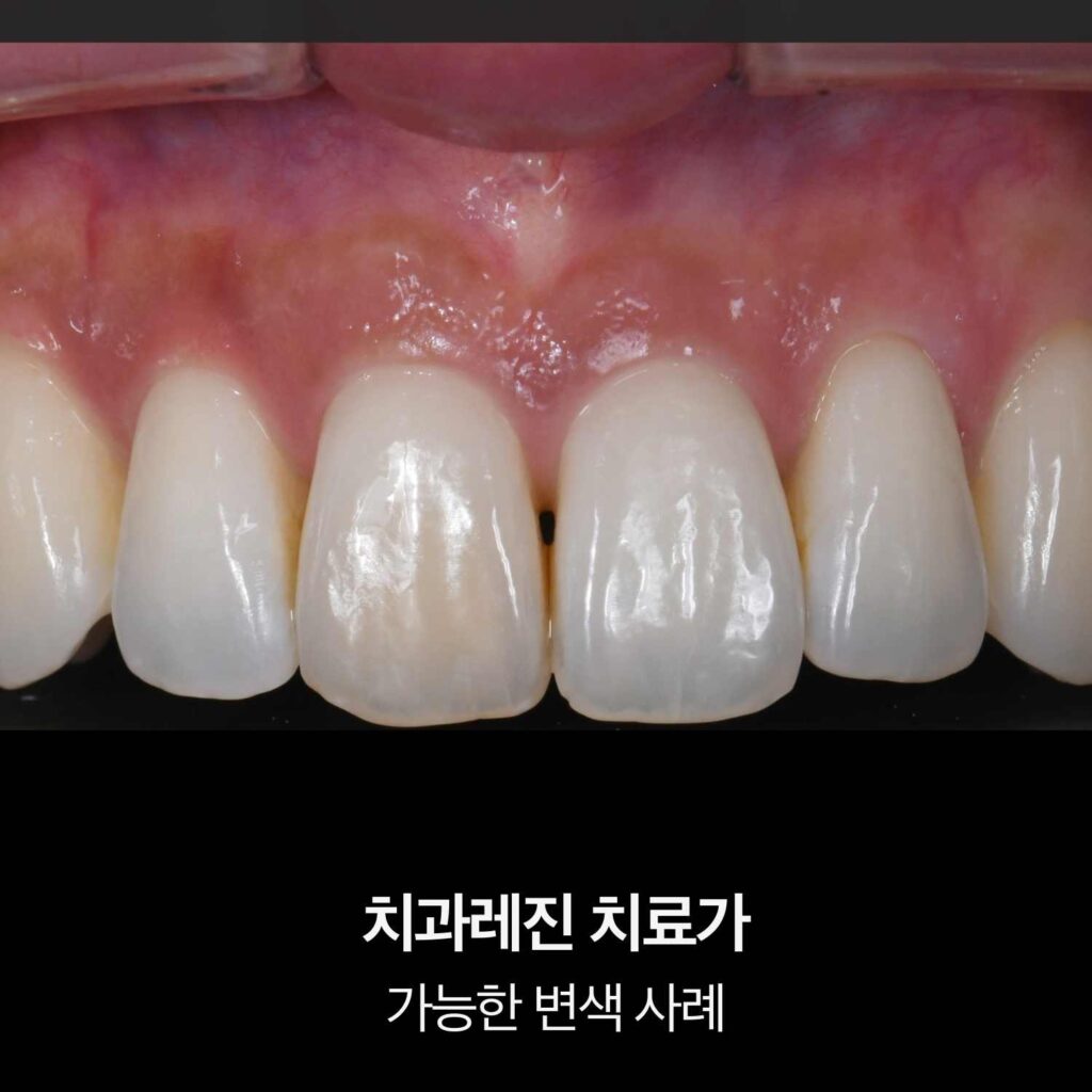 치과레진 치료로 개선 가능한 앞니 변색 사례를 보여주는 치아 사진