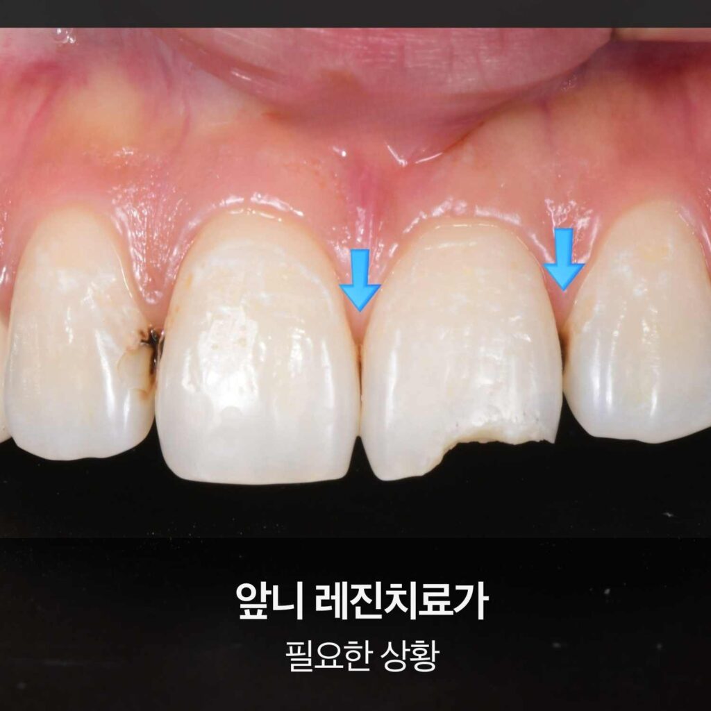 앞니 치아사이충치와 치아 파절이 동시에 나타난 레진치료 필요 사례