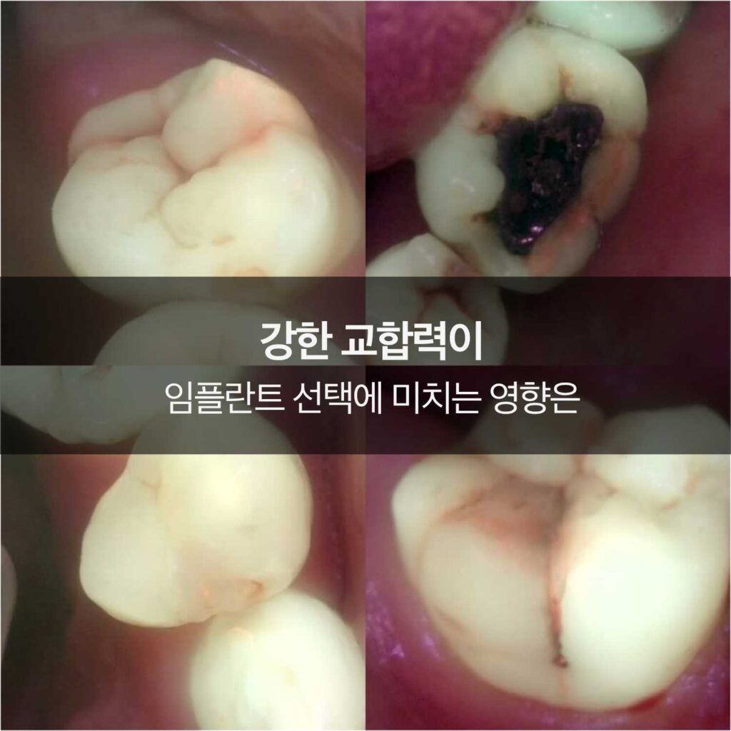 강한 교합력으로 인한 치아 파절과 균열 사례 이미지