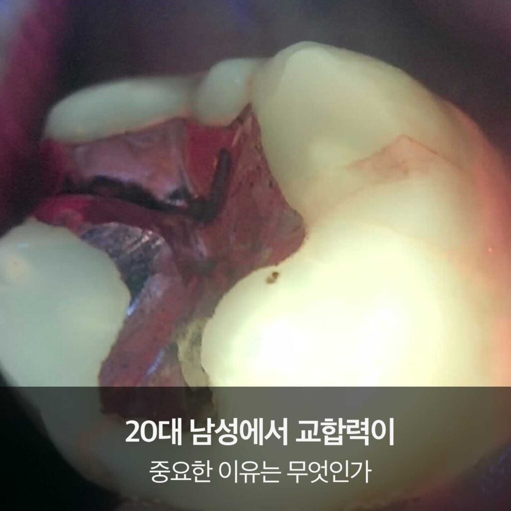 20대 남성에서 교합력으로 인해 치아 손상이 발생한 구강 사진