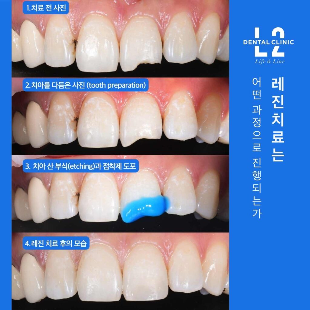 앞니 레진치료 과정 치아 삭제 산부식 접착 후 수복 단계 설명 이미지