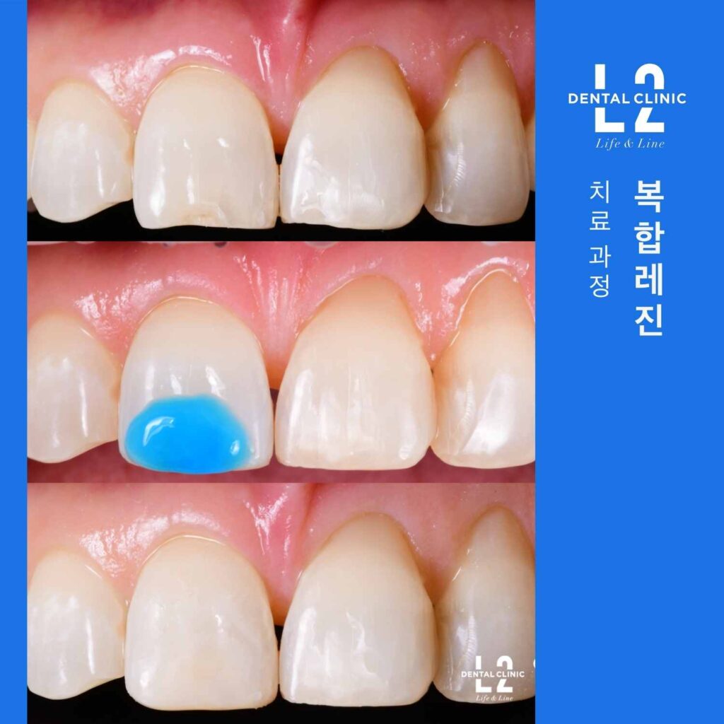 복합레진 치료 과정 앞니 충치 제거 후 레진 수복 과정