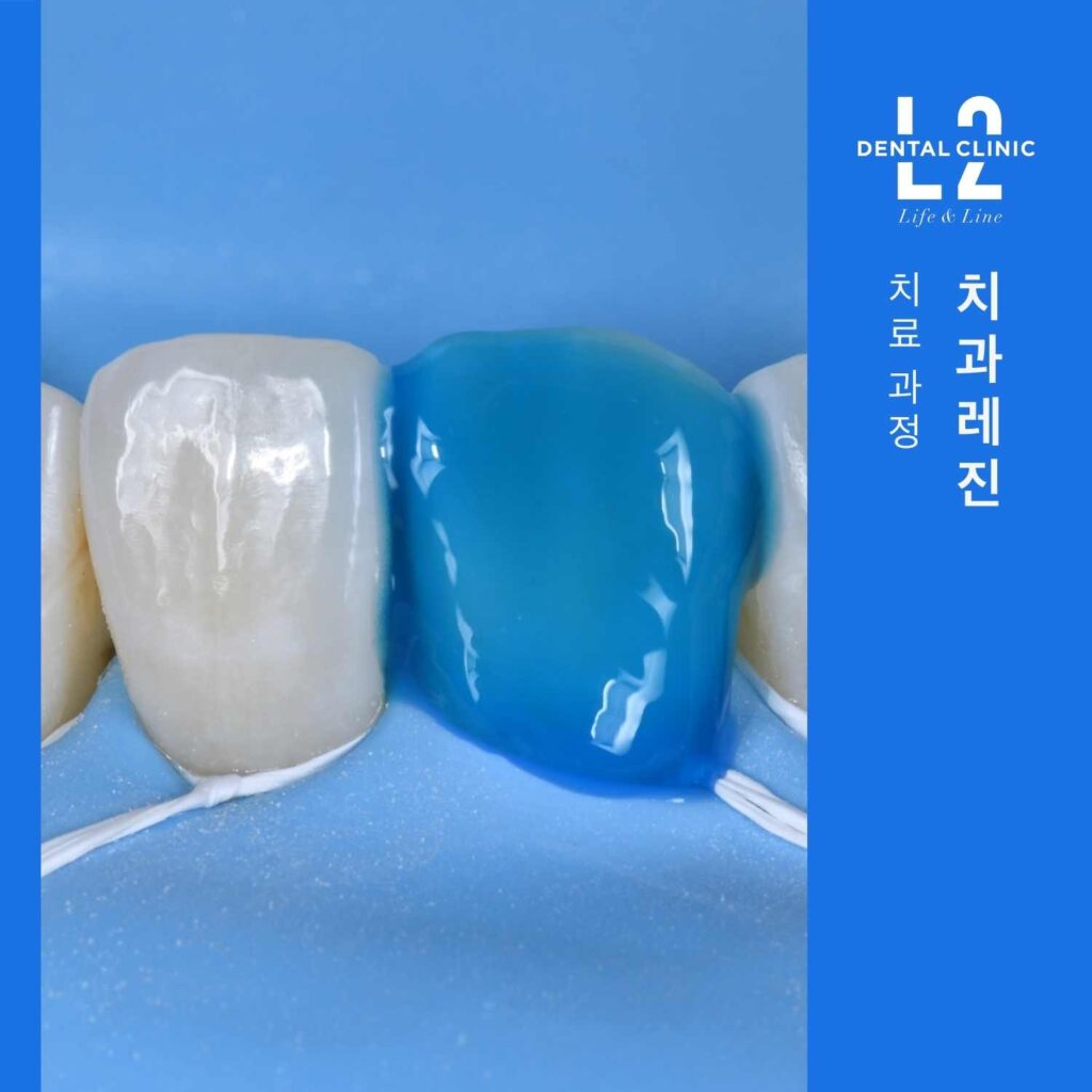 앞니 치과레진 치료 과정에서 산부식과 레진 적층을 진행하는 모습