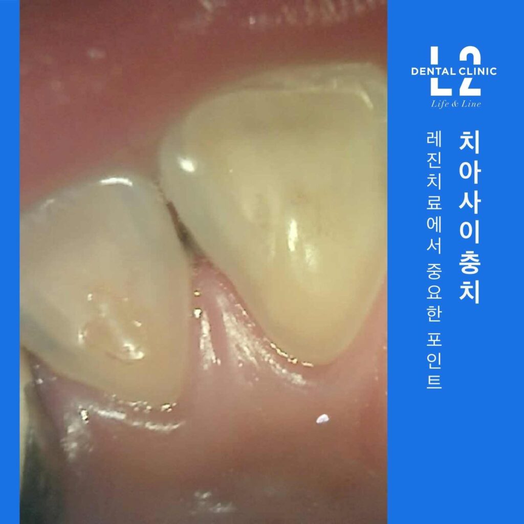 치아 사이 충치 레진치료 시 접근 방향과 접착 부위를 보여주는 임상 사진