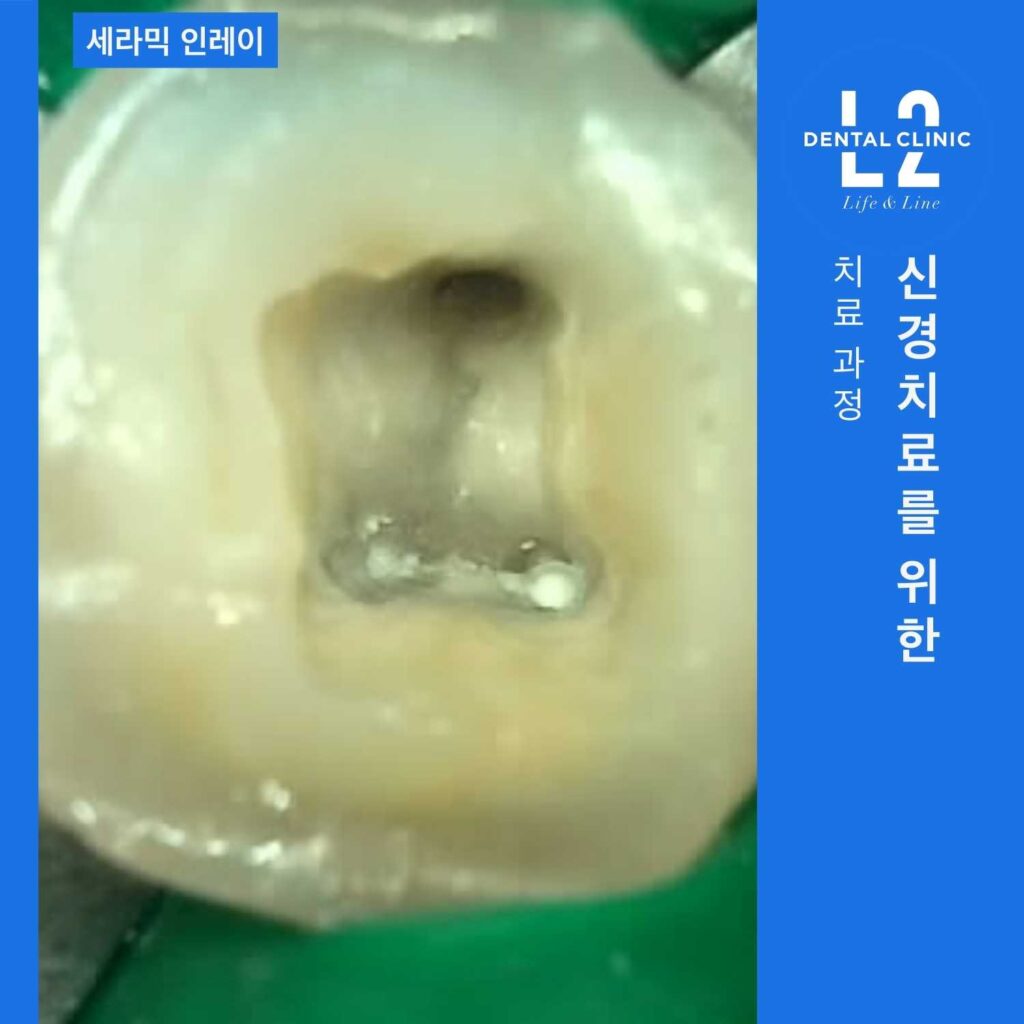 어금니통증 치료를 위해 진행된 신경치료 준비 과정