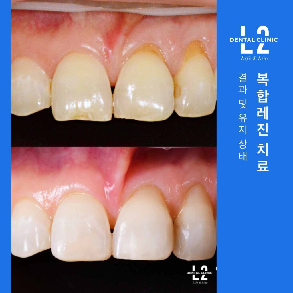 복합레진 치료 전후 비교 앞니 깨짐 변색 개선 결과