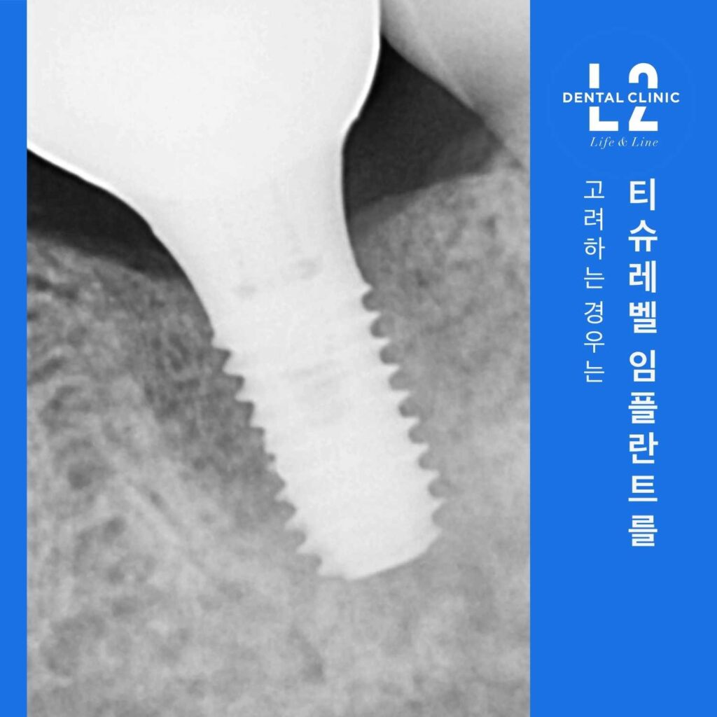 티슈레벨 임플란트 식립 방사선 이미지